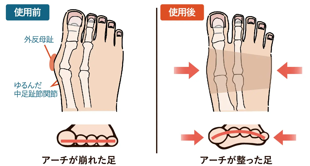 足裏アーチを補助